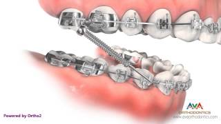 Orthodontic Treatment for Overjet Overbite  Forsus Appliance [upl. by Sirapal]