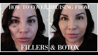 HOW TO COVER BRUISING FROM FILLERS amp BOTOX [upl. by Arman]