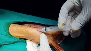 Wrist Joint Pain Treatment Dequervains Tenosynovitis Injection Technique by DrVishal Gunjal [upl. by Wilkie]