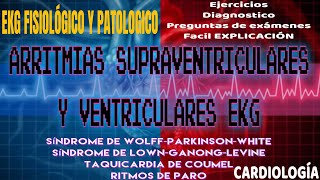 cardiología  ARRITMIAS SUPRAVENTRICULARES Y VENTRICULARES ekg Síndromes de Wolff Lown Coumel [upl. by Melony]