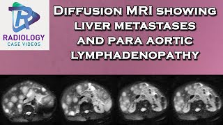 Diffusion MRI showing liver metastases and para aortic lymphadenopathy [upl. by Sarson109]