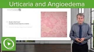 Urticaria Hives and Angioedema – Pediatrics  Lecturio [upl. by Angy]