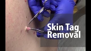 Skin Tag Removal  Dr Derm [upl. by Eirahs]