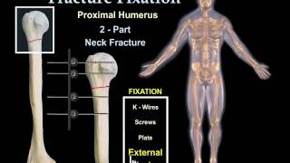 Fracture Fixation Animation  Everything You Need to Know  Dr Nabil Ebraheim [upl. by Ecnar]