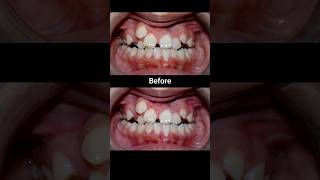 20 months Braces Transformation braces dentist orthodontist dental [upl. by Hajed965]