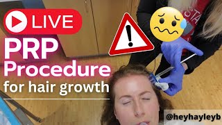 Live PRP Procedure for hair growth [upl. by Nnateragram]