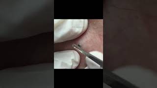 This Weeks TOP Extractions with Dr Pimple Popper [upl. by Sassan758]