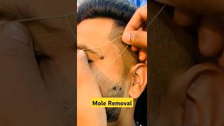 How to remove a mole moles moleremoval shorts drniveditadadu [upl. by William]