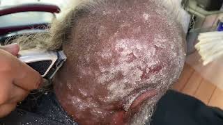 Painful 😓 dandruff old flakes scratching by old man 👴 how to get rid of dandruff🥵 [upl. by Iliak]