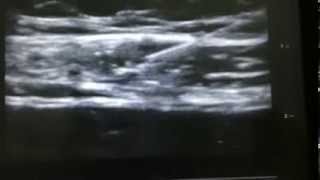 ultrasound guided subcostal tap block [upl. by Jamesy]