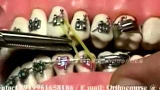 Cl II Cl III Elastics in Orthodontics [upl. by Rollins]