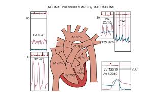 Right Heart Catheterization  an introduction [upl. by Hut258]