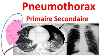 Pneumothorax spontané primitif secondaire Radiologie douleur thoracique traitement Anatomie plèvre [upl. by Enaenaj]