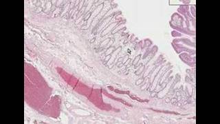 Histopathology ColonTubular adenoma adenomatous polyp [upl. by Ojela]