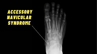 BEST Exercises for Accessory Navicular Syndrome [upl. by Towney]