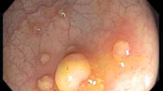 Colonoscopy Channel  Pseudomembranous colitis [upl. by Stephenson115]