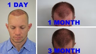 Hair Transplant 3 Month Update [upl. by Gone203]