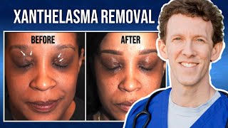 Removing Xanthelasma with Lasers  Thirzas Testimonial [upl. by Ynnatirb371]