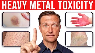 4 Skin Signs That Reveal Heavy Metal Toxicity [upl. by Karyl]