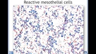 Prof JFのレクチャー Pathology of mesothelial cells [upl. by Ahseyk467]