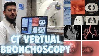 CT Vertual Bronchoscopy Post Processing Filming Process radiology [upl. by Suiramed863]