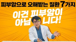 피부암으로 오해받는 피부 양성종양 7가지 이건 꼭 확인하셔야 해요 [upl. by Bryanty]