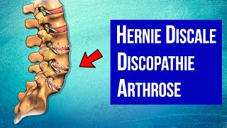 Hernie discale Discopathie Arthrose  Mieux comprendre son mal de DOS [upl. by Ahmad]