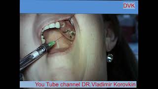 Infiltration Anesthesia for extration 232627 teeth [upl. by Rucker514]