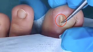 【Daily Pedicure Tutorial】 Pulling Out The Deeply Embedded Ingrown Nail Instantly Brought Relief [upl. by Sosna]