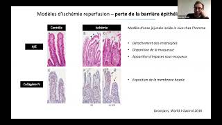 Ischémie mésentérique  Simon BOURCIER [upl. by Ahsiener767]