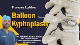 Balloon Kyphoplasty explained by Dr Abhishek Kumar Mishra [upl. by Eynaffit]