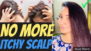 DIY  Extreme DRY amp ITCHY SCALP Treatment at Home  Magical Remedy For LICE SCALP ACNE amp DANDRUFF [upl. by Lindly]