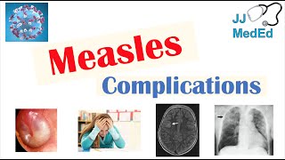 Measles Complications Immunosuppression Encephalitis SSPE etc Diagnosis Treatment Prevention [upl. by Byrn566]