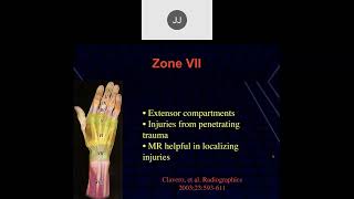 MRI of the Wrist Part 8  Wrist Tendons [upl. by Yrolam]