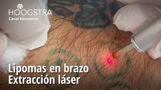 Lipomas en brazo  Extracción láser  24121 [upl. by Tedi]