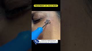 Treatment of face wart  By Dr Uttam Kumar Lenka MBBS MD Consultant Dermatologist [upl. by Liauqram]