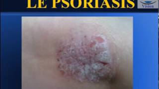 Psoriasis Formes cliniques et physiopathologie [upl. by Jessie]