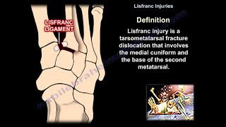 Lisfranc Injuries  Everything You Need To Know  Dr Nabil Ebraheim [upl. by Rumit]