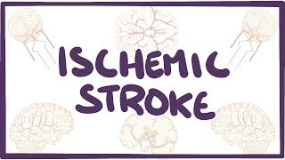 Ischemic Stroke  causes symptoms diagnosis treatment pathology [upl. by Helgeson]