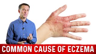 Is Your Eczema Coming from a Salicylate Sensitivity – Dr Berg On Atopic Dermatitis [upl. by Nanoc]