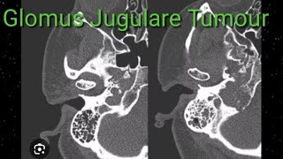 Glomus Jugulare Tumour Easy to understand on Radiology CT images [upl. by Atinihc]