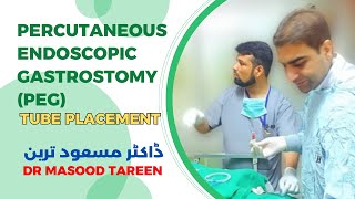 Percutaneous endoscopic gastrostomy PEG tube placement  Dr Masood Tareen [upl. by Irahc]