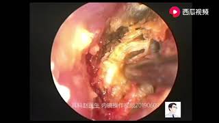 Typical cases of cholesteatoma [upl. by Iram705]