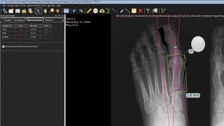 TraumaCad Foot Osteotomies Wizard [upl. by Kristoforo]