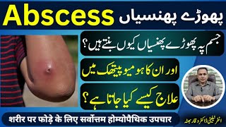 Abscess پھوڑے پھنسیاں फोड़ा Homeopathic Treatment By Dr Waqar Bhutta In Urdu Hindi [upl. by Nickolaus]