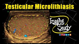 Testicular Microlithiasis  Ultrasound  Case 334 [upl. by Jem]