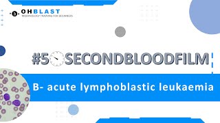 50SecondBloodFilm Bacute lymphoblastic leukaemia [upl. by Yniattirb769]