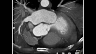 Cardiac Coronary anatomy 1 of 3 [upl. by Ennavoj55]