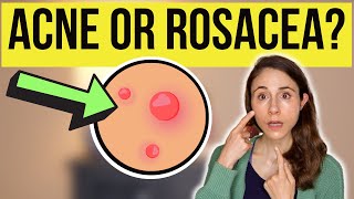 IS IT ACNE OR ROSACEA 😳 Dermatologist DrDrayzday [upl. by Seadon]