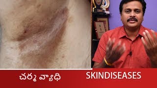 HOW TO SOLVE ERYTHRASMA SKIN DISEASES IN TELUGU CORYNEBACTERIUMHOMEOPATHIC TREATMENT WAKEUP [upl. by Anairotciv]